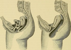 blog.pondering.pelvic.prolapse